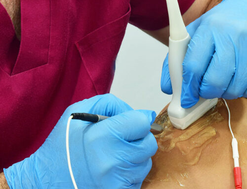 Electrólisis Percutánea o EPI ¿Qué es?