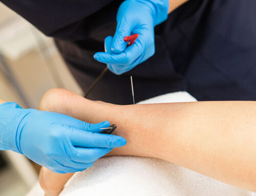 Punción seca puntos gatillo