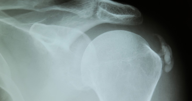 calcificacion radiografía con calcificación