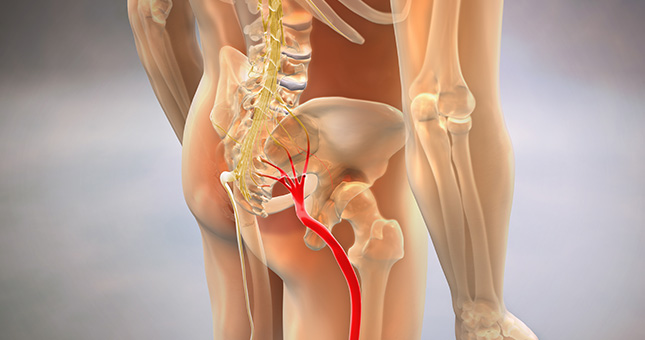 ciatica esquema de ciatica