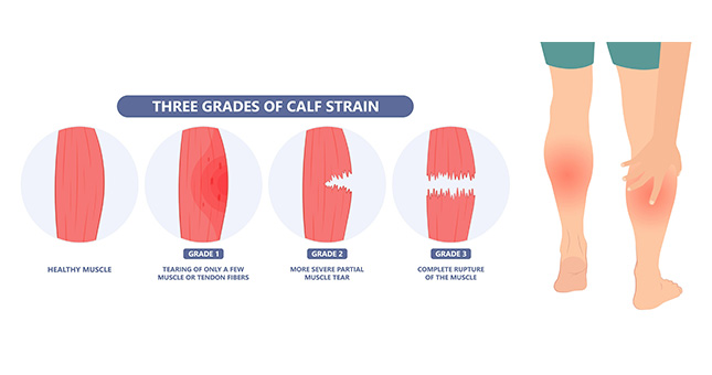 rotura_fibras esquema rotura de fibras