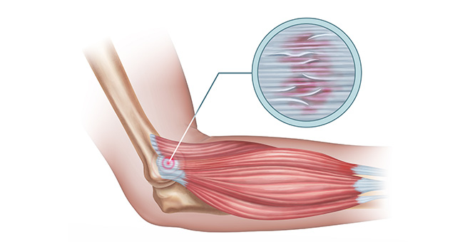 tendinosis esquema de tendinosis